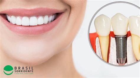 implante dentário preço popular.